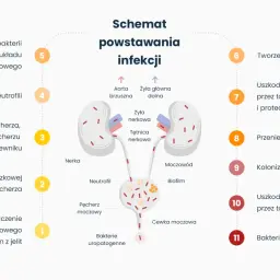 Schemat powstawania infekcji dróg moczowych, prowadzącej do zapalenia pęcherza. Opisuje etapy od kolonizacji do bakteriemii.