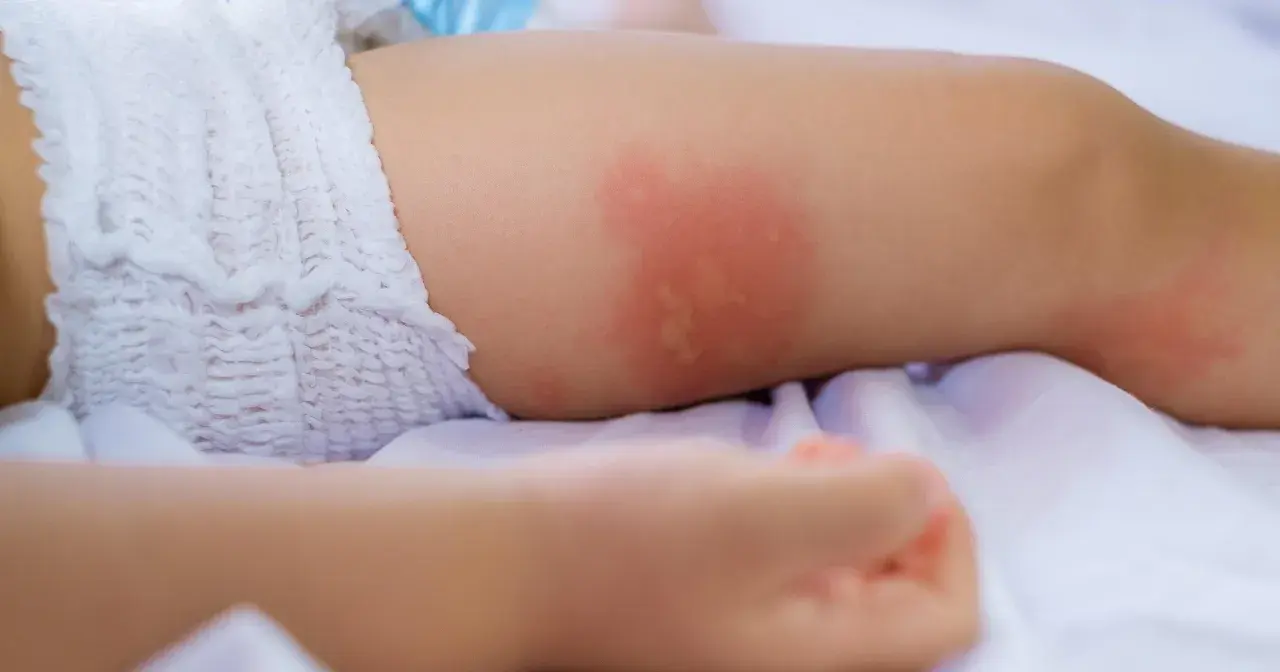 Rumień u dziecka - kiedy to infekcja, a kiedy alergia?